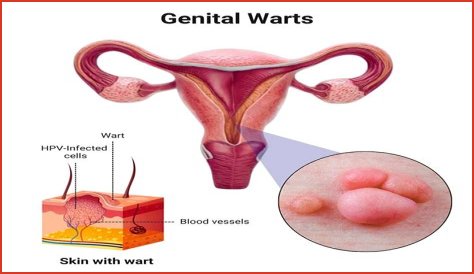 Can genital warts appear during pregnancy?