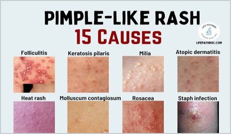 What is a rash that looks like pimples?